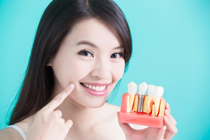 Dental Implant in Dubai