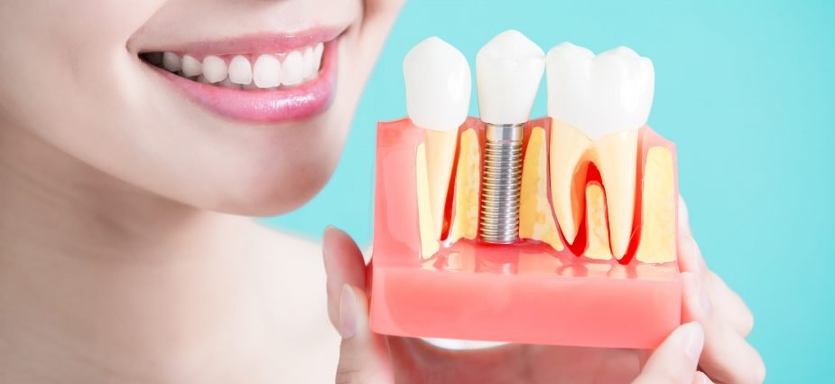 Dental Implants in Dubai