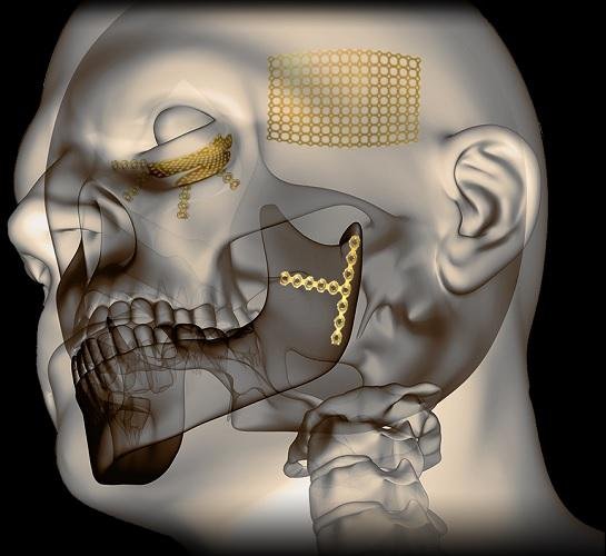 Craniomaxillofacial Implants Market