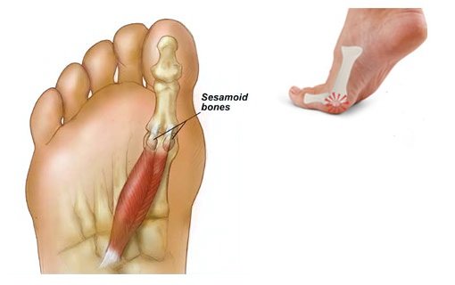 Sesamoid Fractures